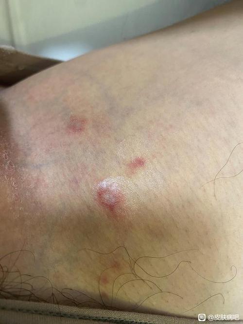 男人大腿内侧敏感
