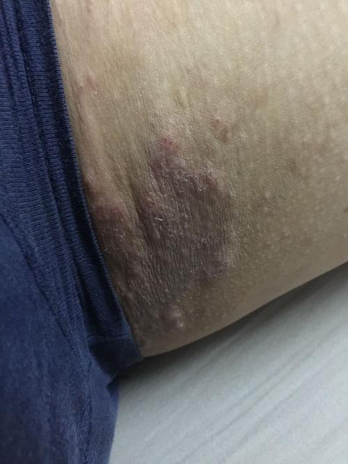 男人大腿内侧敏感