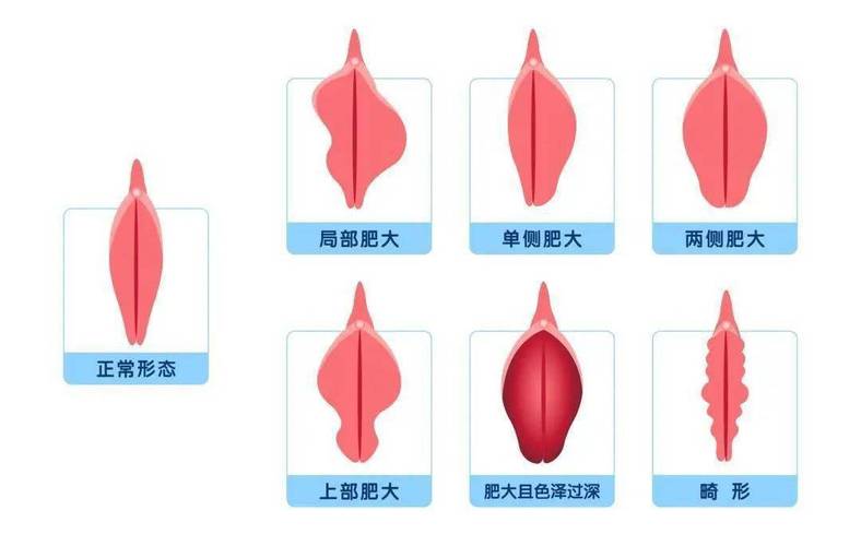 小阴唇敏感总疼痛？肥大矫正3招提升舒适度｜2025实测 - 两性知识丨两性健康-你想了解的我都知道两性知识-两性健康-两性心理-两性技巧两性知识丨两性健康--你想了解的我都知道