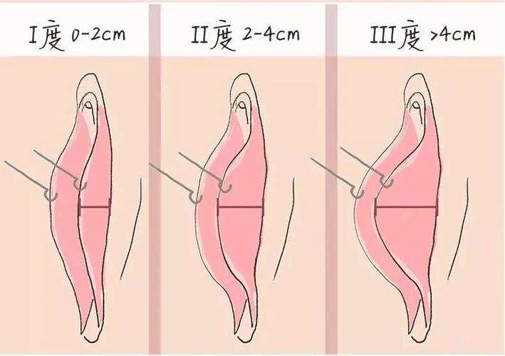 小阴唇敏感