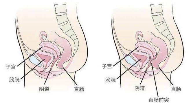 阴道后壁敏感｜3步科学缓解法，舒适度+80% - 两性知识丨两性健康-你想了解的我都知道两性知识-两性健康-两性心理-两性技巧两性知识丨两性健康--你想了解的我都知道